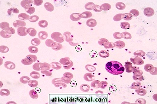 Wat is essentiële trombocytose, symptomen en behandeling