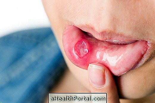 What can be and how to treat the sore in the mouth