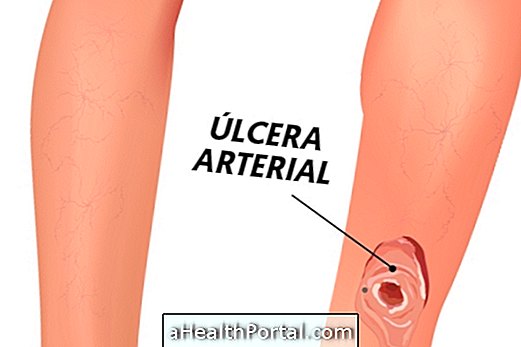 Come trattare un'ulcera arteriosa