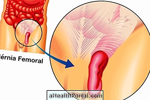 Belangrijkste symptomen van femorale hernia en hoe de behandeling is voltooid