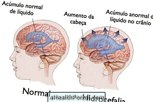 Czy Hydrocephalus Cure?