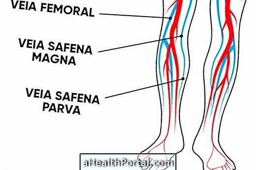 Како је операција сапена за уклањање вена за лечење варикозних вена?