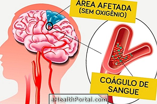 Cum să identificați și să tratați tromboza cerebrală