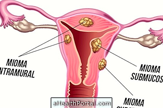 Myoma suberous là gì và các triệu chứng là gì