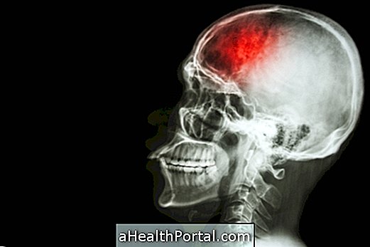 Cerebral ischemia: apa itu, mayor dan gejala dan kemungkinan gejala sisa