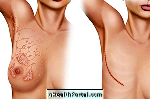 5 ประเภทที่สำคัญของ mastectomy และวิธีการที่พวกเขาจะทำ