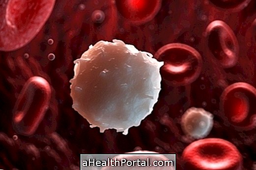 Nhiều Myeloma: Nó là gì, triệu chứng và điều trị