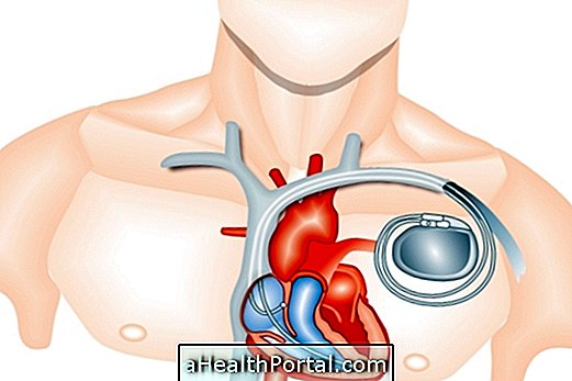 Kardiostimulátor: co je a péče po umístění