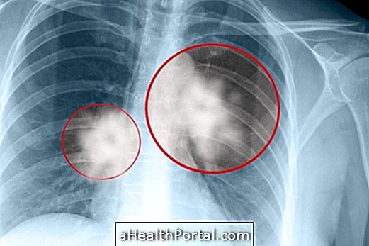 Lung Spot: Những gì có thể trở thành