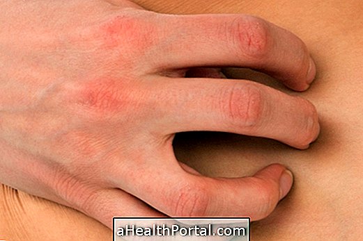 Dermatophytosis: Triệu chứng và điều trị