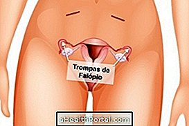 Tubal Ligation: Nó là gì, làm thế nào nó được thực hiện và Ai có thể làm điều đó