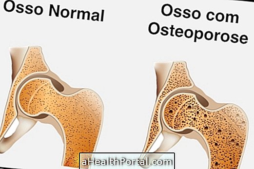 Liečba osteoporózy