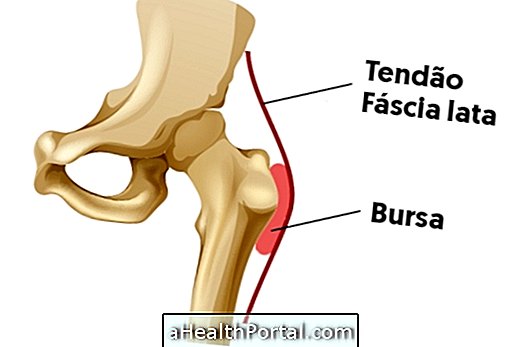 Apakah bursitis di pinggul dan latihan yang disyorkan