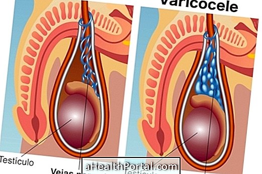 Varicocele ở trẻ em và thanh thiếu niên