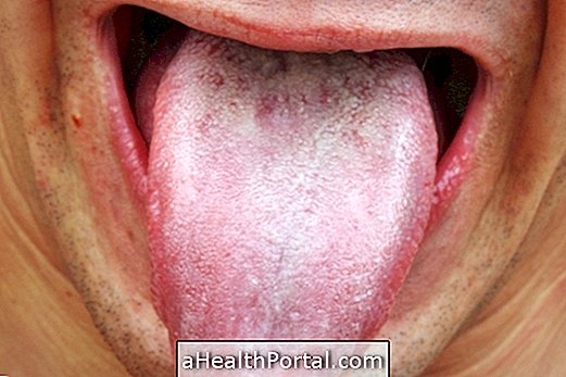 leukoplakia คืออะไรและวิธีการรักษา