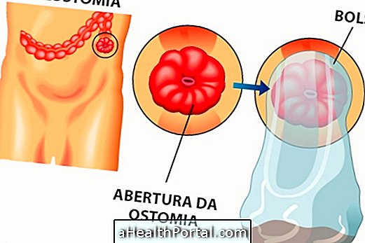 Ako sa starať o kolostómiu a ileostómiu