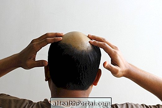 All About Hair Transplant