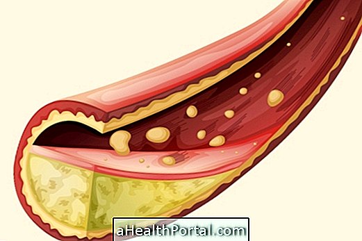 What is greasy embolus and how does it happen