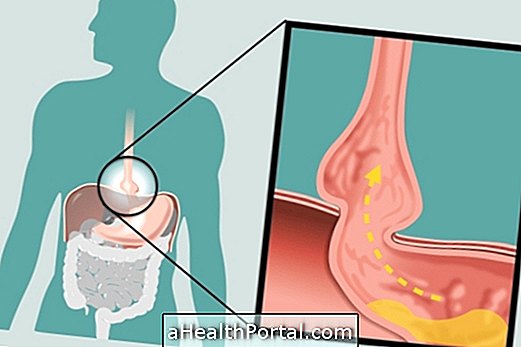 Mi az a diaphragmatic hernia, fő típusai és hogyan kell kezelni