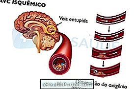 Aflați ce se poate întâmpla după ce ați avut un accident vascular cerebral