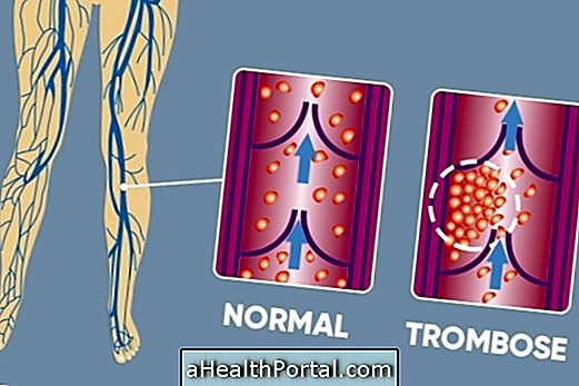 DVT: Što je, liječenje, komplikacije i prevencija