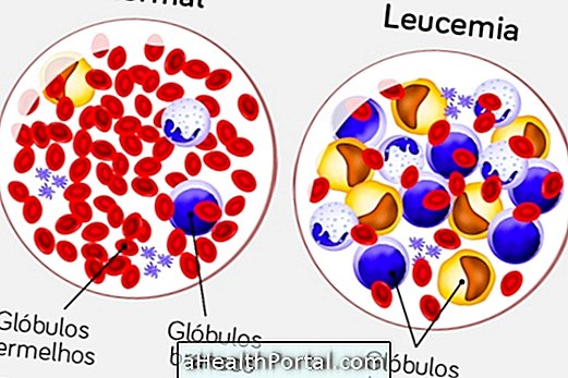 Leukemia Lymphoid: apa itu, simptom utama dan bagaimana merawatnya