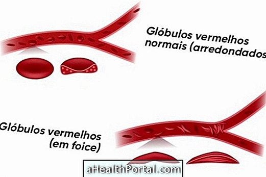 Vad är sicklecellanemi, orsaker och hur behandlas behandlingen?