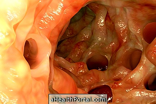 5 Tips untuk Hidup Sehat Dengan Diverticulitis