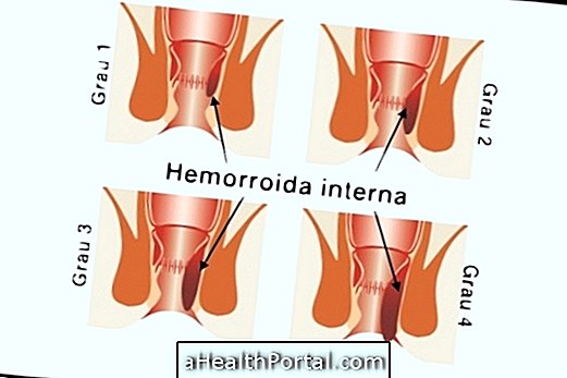 Comment classer les hémorroïdes internes