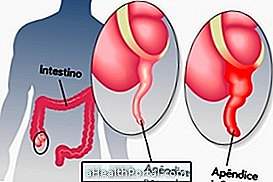 Smerte af appendicitis: ved hvad man skal gøre