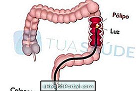 Cunoașteți cauzele și modul de tratare a polipilor intestinali