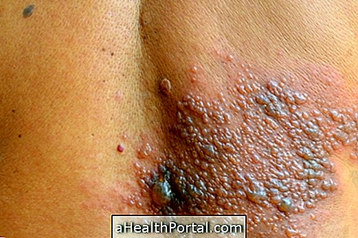 Apa dan bagaimana mengobati dermatitis herpetiformis