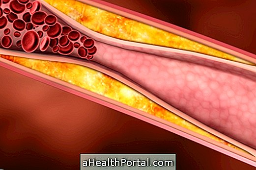 Mi az, és hogyan kezeljük az Aortic Atheromatosis-ot?