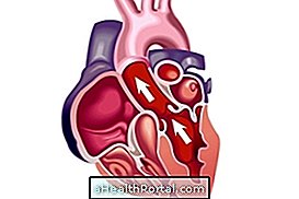 What are the symptoms of dilated heart