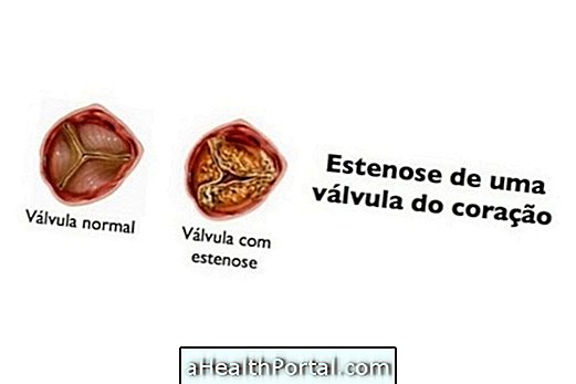 Aortic Stenosis: Apa Adanya, Gejala dan Pengobatan