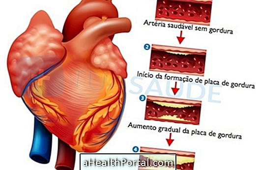 Az aorta meszesedése