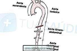 Bagaimana mengetahui apakah saya bisa mengalami aneurisma aorta