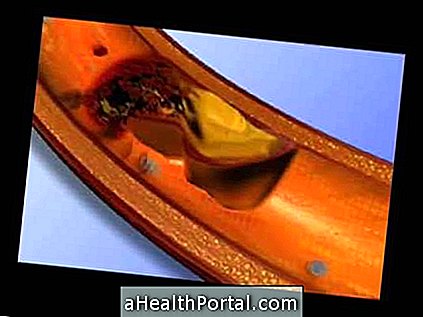 atherosclerosis