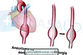 Zdravljenje aneurizme aorte