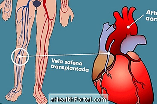 Phẫu thuật tĩnh mạch hoại tử được thực hiện như thế nào?