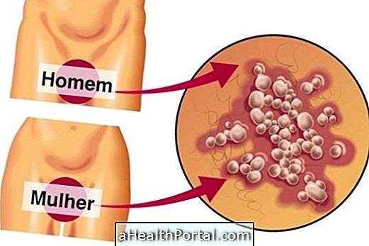 Je li Genital Herpes Cure?