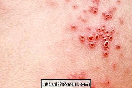 Tìm hiểu làm thế nào để có được herpes sinh dục và biết điều trị của bạn