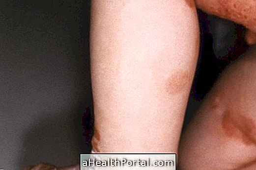 How is the treatment for epidermolysis bullosa