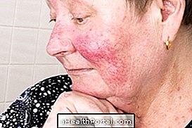 Rosacea อาการอาการประเภทสาเหตุและการรักษาคืออะไร