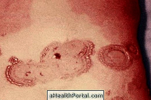 Eritema Multiforme: che cos'è, sintomi e trattamento