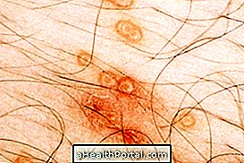 Molluscum contagiosum