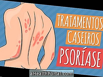 Bästa behandlingar för psoriasis