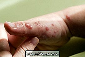 Apakah Epidermolisis Bullosa Distrófica dan bagaimana untuk merawatnya