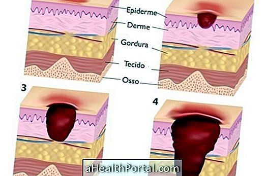 Những gì là bedsores và làm thế nào để tránh nó