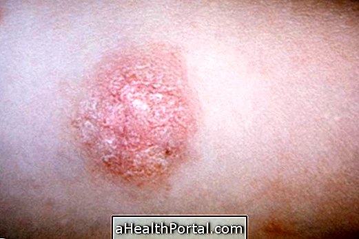 Какие причины и как лечить pityriasis rosea